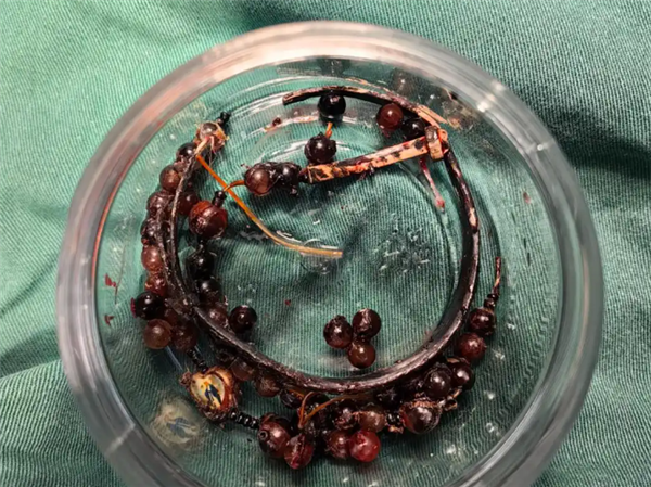 33岁女子戴手镯10年不摘：长胖后嵌进肉里导致严重感染