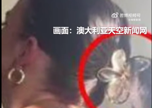 澳大利亚女子驾车遭追尾 头上鲨鱼发夹断裂致脑震荡