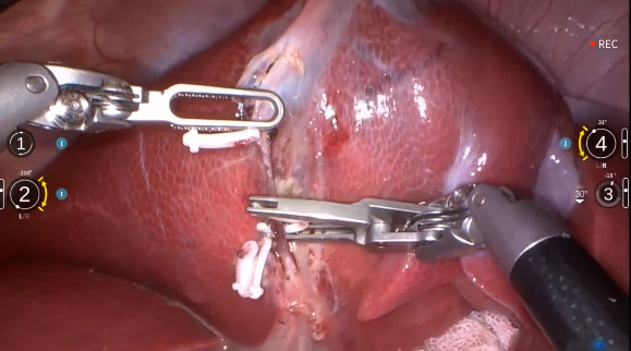 多重突破！微创机器人完成全球首例“大模型自主手术”动物实验